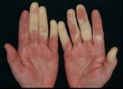 指の爪の生え際が膨らんだり 赤黒かったり テカテカ光っていませんか しもやけの治療 蛭間医院