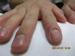 指の爪の生え際が膨らんだり 赤黒かったり テカテカ光っていませんか しもやけの治療 蛭間医院