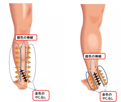 手術後の部位が痛んだり、違和感がある方はいらっしゃいませんか？（ケロイドの対処法） | 蛭間医院