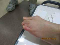 骨折後や脱臼後の指の曲がりにくさが改善した例 蛭間医院
