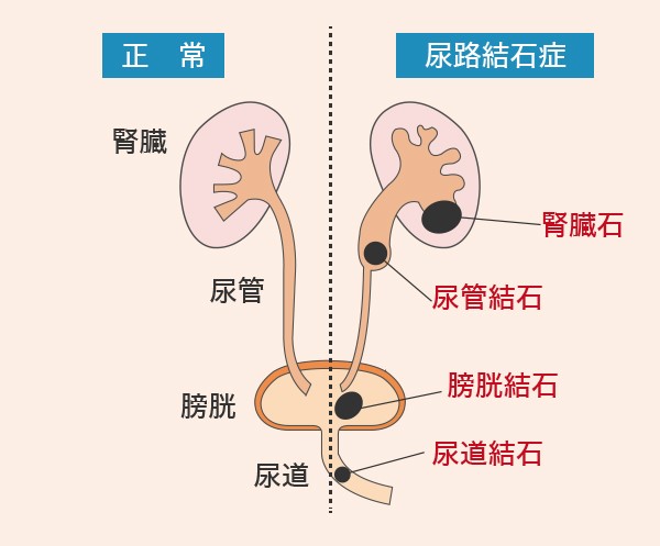尿管結石の痛みの解消法 | 蛭間医院